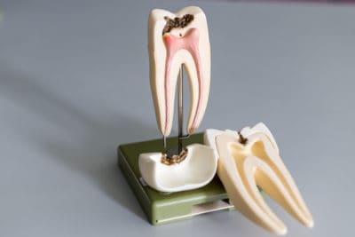The Not So Scary Truth About Root Canals