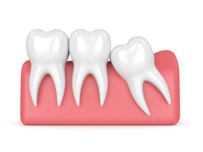 Do You Really Need to Have Your Wisdom Teeth Removed?