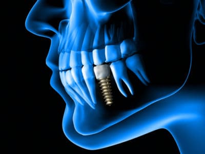 dental implant