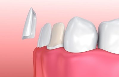 What Are Dental Veneers?