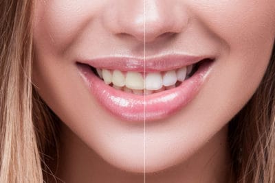 The Truth Behind DIY Smile Whitening Trends