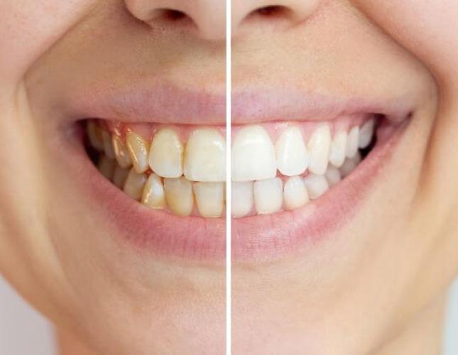 Do Natural Teeth Whitening Remedies Really Work?