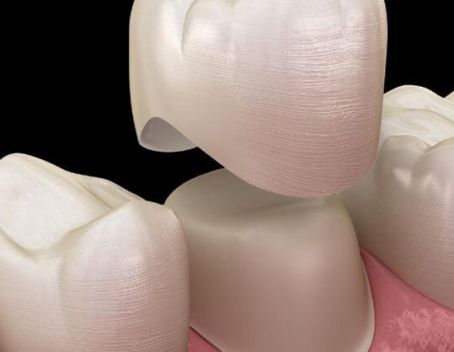 Types of Dental Crowns: Choosing the Right Material for Your Smile