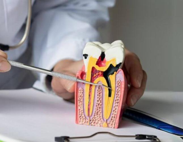What to Expect During a Root Canal